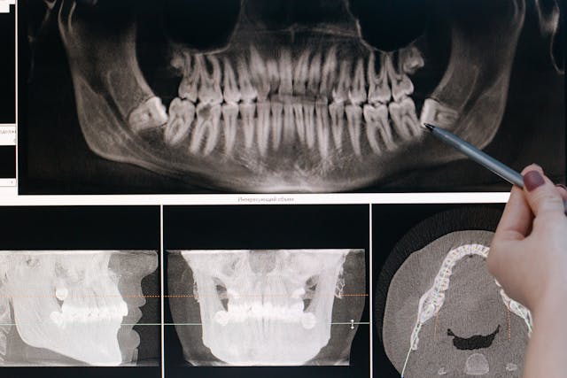 tooth xray